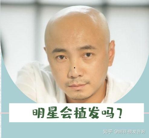 植发明星爆料视频大全,揭秘脱发困扰与美丽蜕变之路